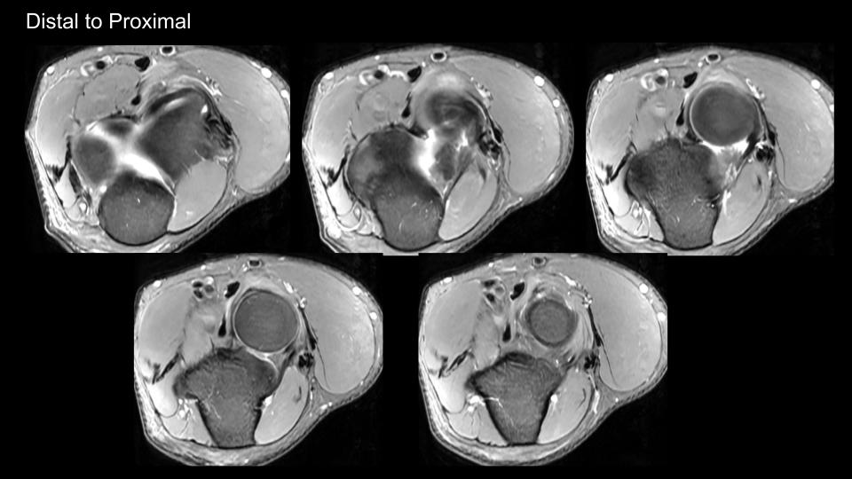 Figure 4 for case Volar dislocation of the radial head